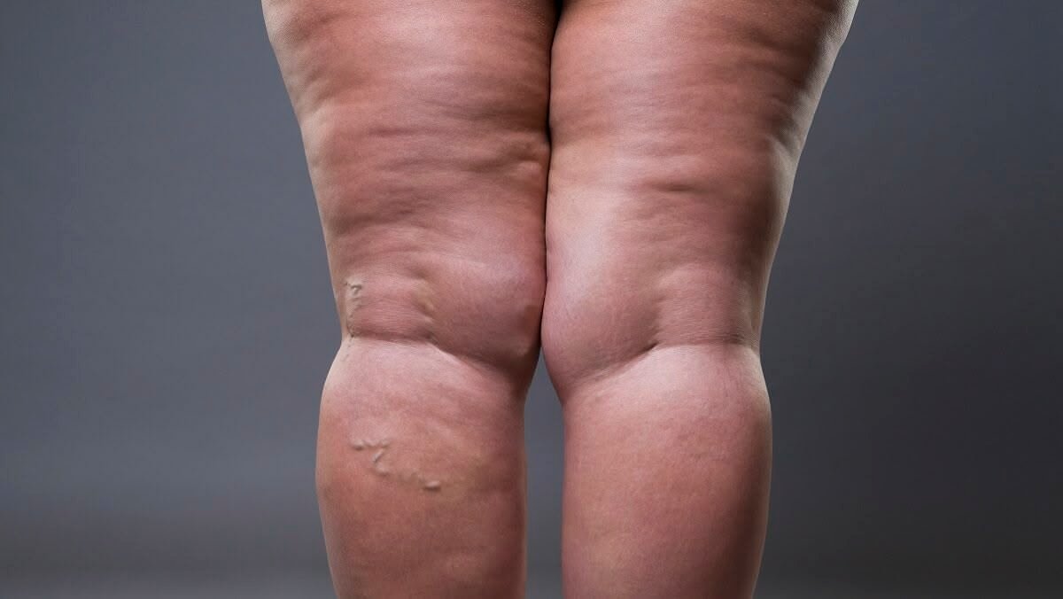 Lipedema — gordura desproporcional nas pernas