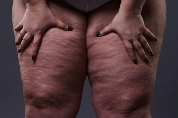 Lipedema — tratamento sem diagnóstico não funciona